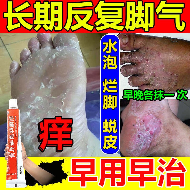 硝酸咪康唑乳膏 脚气药止痒脱皮烂脚丫真菌感染止痒 药 水泡糜烂 治疗