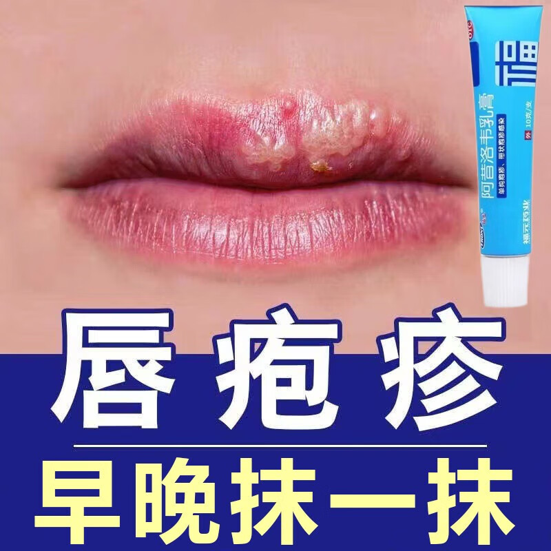 阿昔洛韦乳膏 治疱疹感染嘴唇疱疹药膏 疱疹感染引起嘴角疱疹上火起泡