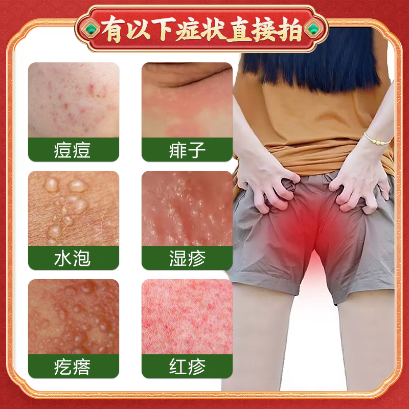 千草本原屁股痒 起疙瘩癣屁股湿痒久坐长痘痘坐板疮硬块闷头止痒膏 1盒装【多买多送】