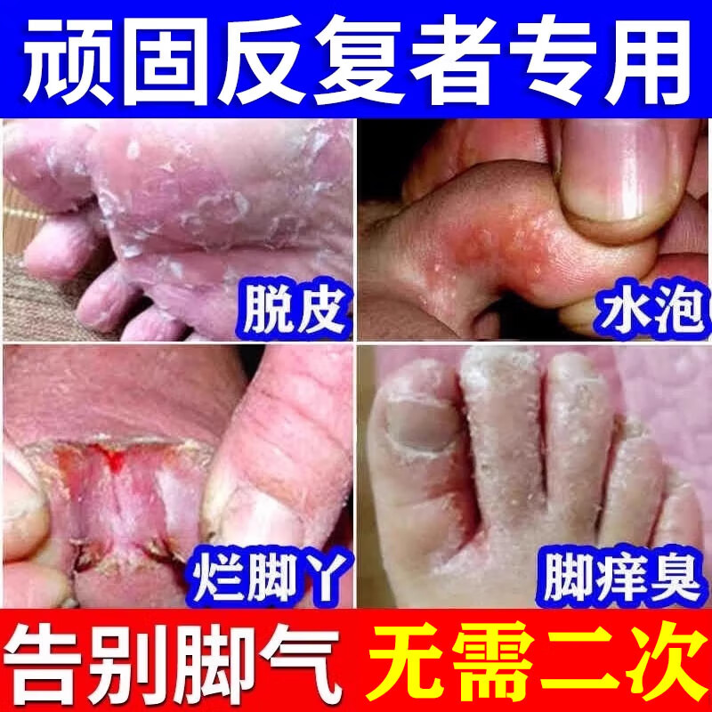 硝酸咪康唑乳膏可搭配散粉使用脚气药止痒脱皮烂脚丫真菌感染止痒治