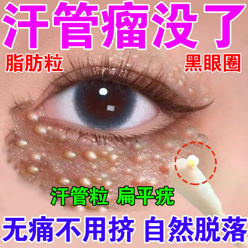 脂肪粒去除神器眼部专用汗管瘤去除神器油脂粒汗管瘤眼部去除脂肪 单