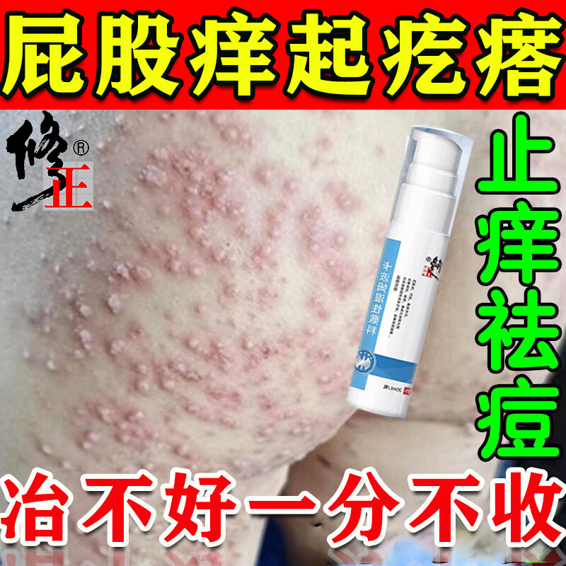 修正屁股痒起疙瘩屁股上有疙瘩久坐湿疹长痘痘红肿火疖子坐板疮非药