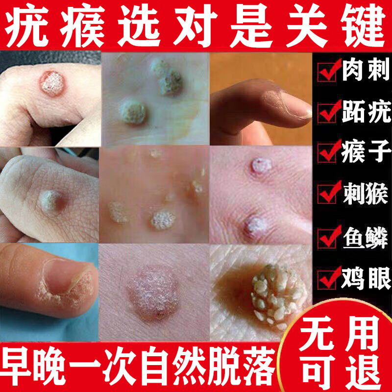 去 疣灵扁平疣面部专用的药脖子瘊子扁平疣特专用效药疣瘊灵去除脖子