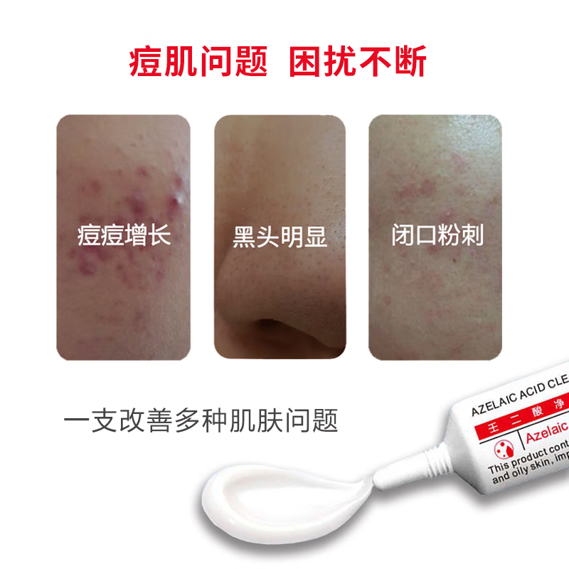 芙诗婷壬二酸15%凝胶乳膏祛痘淡化痘印清洁黑头闭口粉刺油痘肌凝露软膏 3支【15%壬二酸】周期装
