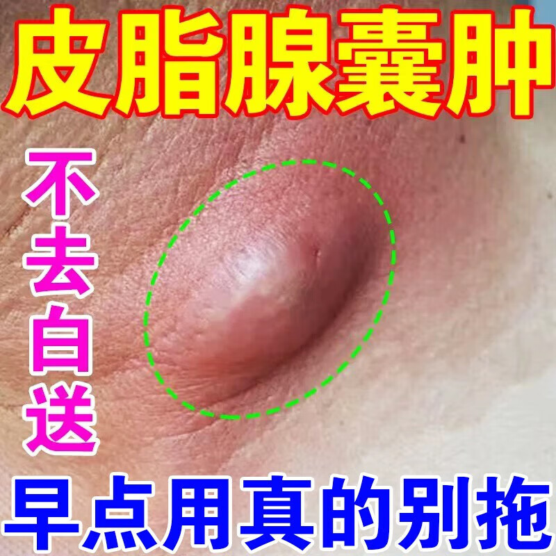皮脂腺囊肿粉瘤痘痘去除膏消皮下脓包火疖子拔1毒神器囊肿速消 1盒