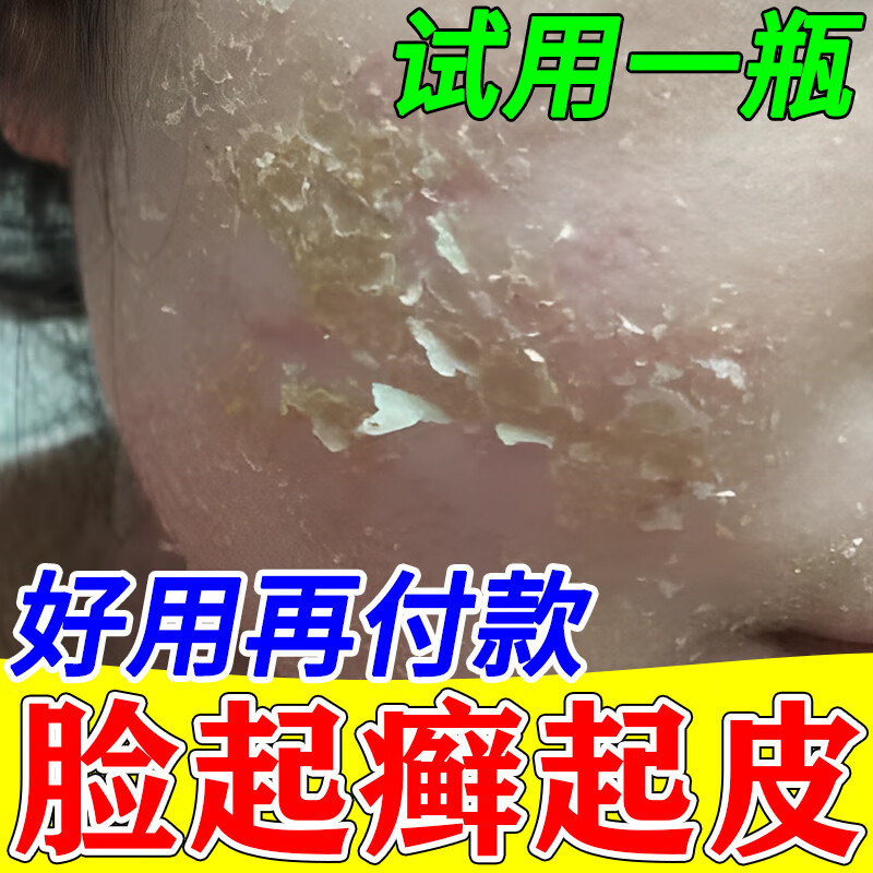 脸上起癣起皮干皮掉皮脸上长癣皮肤干燥脱皮脸上有癣干燥痒保健液 一