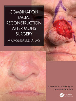 预订 combination facial reconstruction after mohs surgery: a