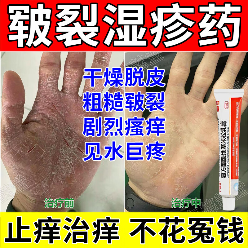 手部角化型慢性湿疹药】手指皲裂性湿疹药膏皮肤瘙痒皮炎湿疹止痒消炎