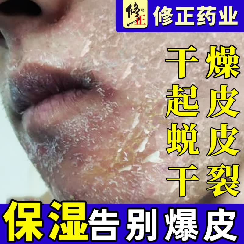 思亚希脸上起皮干燥脸干皮保湿补水止痒脸上脱皮过敏红痒开裂爆皮