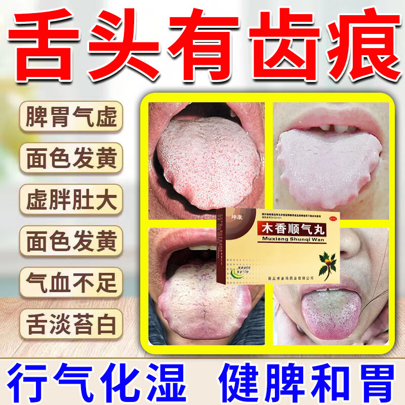 齿痕舌治疗药健脾祛化湿 舌头有齿痕湿气太重吃什么药好裂纹舌药治