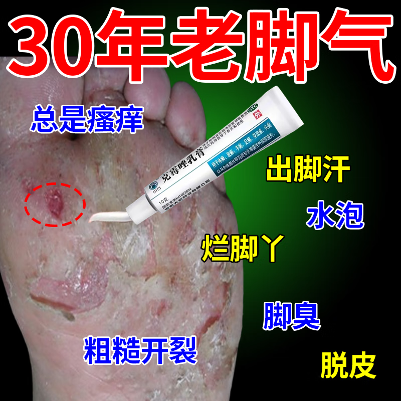 角化型脚气专用药膏】严重脚气脚趾干裂脱皮糜烂水泡脚趾缝烂痒脚臭
