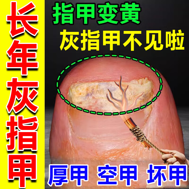 京东官方旗舰店自营灰指甲可搭特有效药根指甲增厚治发黄变空脱甲护甲