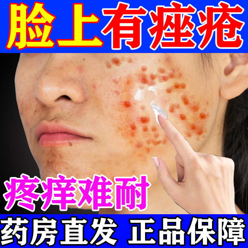 痤疮专otc膏皮肤用凝胶药 脸上长粉剌丘疹脓疱痤疮痘痘的药痤疮膏