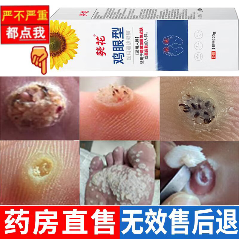 葵花鸡眼型鸡尤康贴药水膏可搭去i根去肉刺手部脚趾底瘊子猴子除肉粒