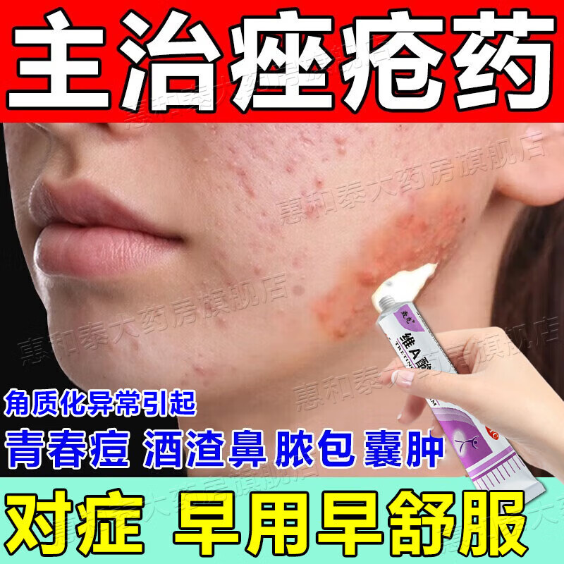 痤疮膏 祛痘 青春痘脓疱疮毛囊炎 治痤疮粉刺痘痘的中药药膏 维a酸