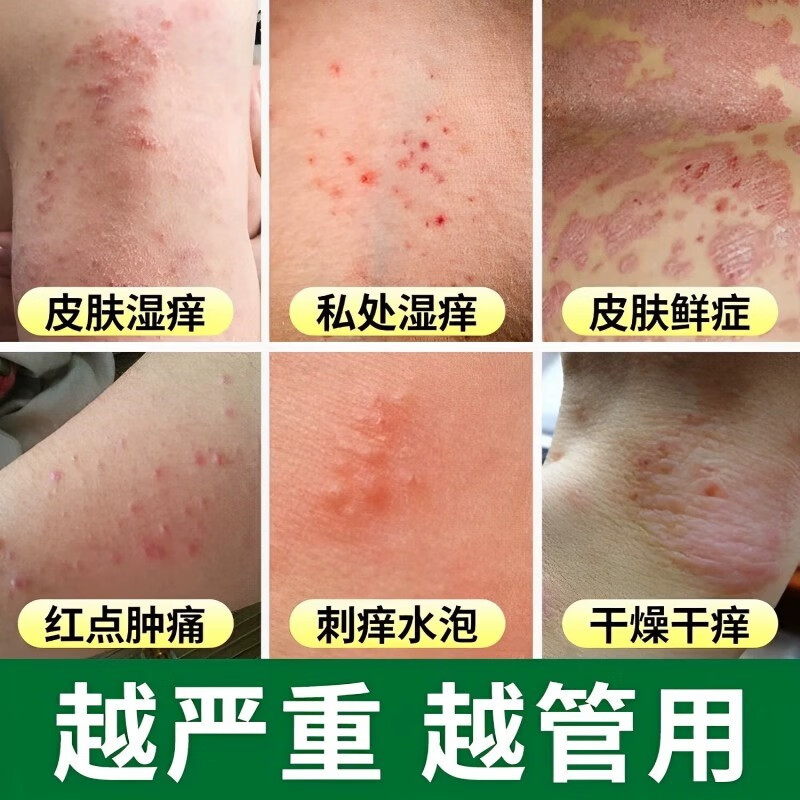 青霉素软膏 抗菌感染私处止痒消i炎皮肤瘙痒外阴大腿内侧阴囊肛门瘙痒