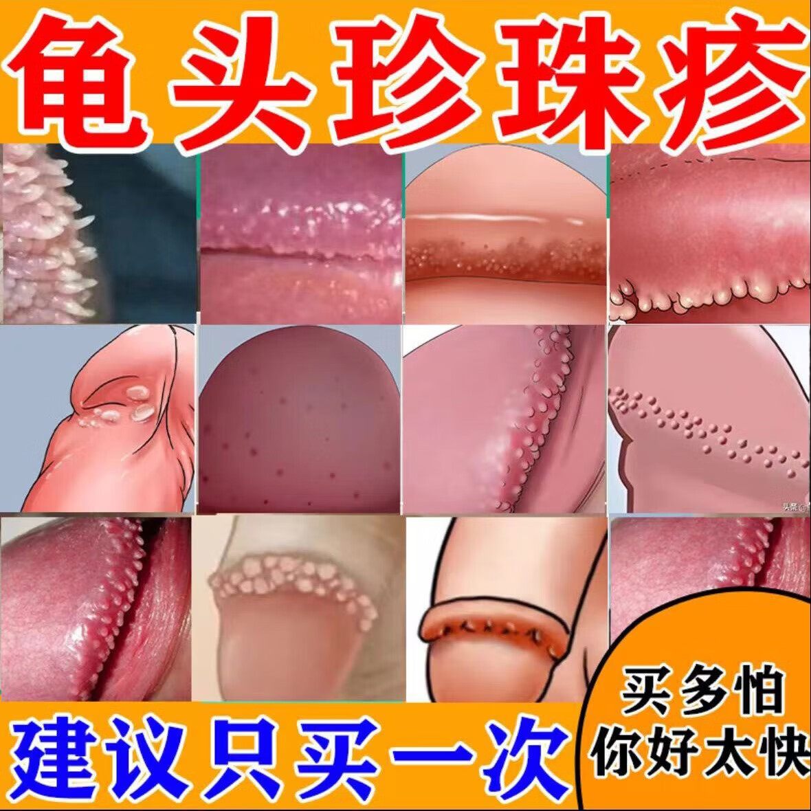 私处护理洗液龟头红肿红斑糜烂瘙痒霉菌念珠型包皮炎排尿疼痛真菌感染