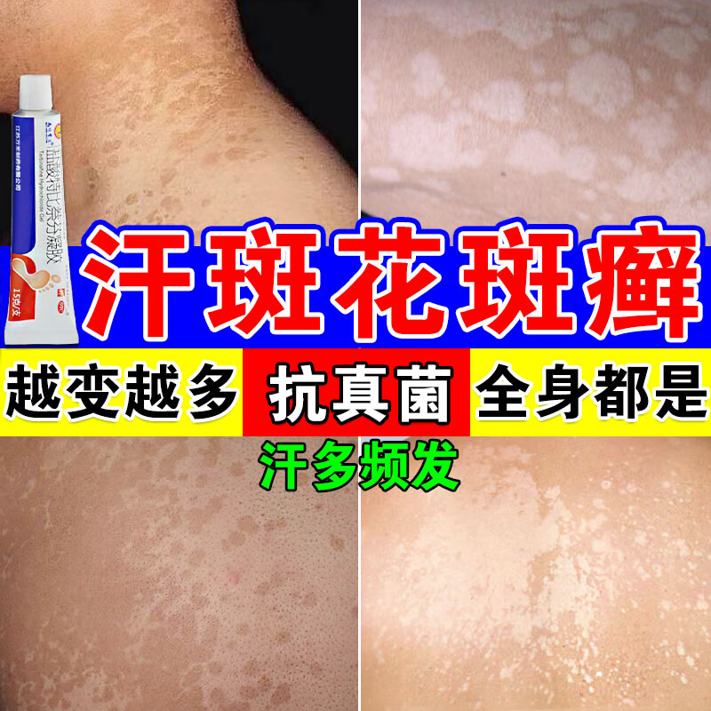 汗斑专用药 治花斑癣除成人儿童汗斑根皮肤瘙痒面部白斑胸前背部片状
