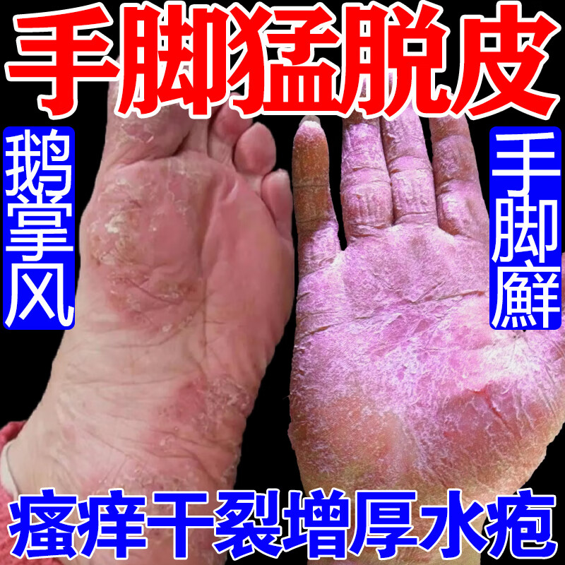 科田脱皮药手癣脱皮干裂鹅掌风干裂脱皮手掌粗糙变厚真菌感染手足藓脱