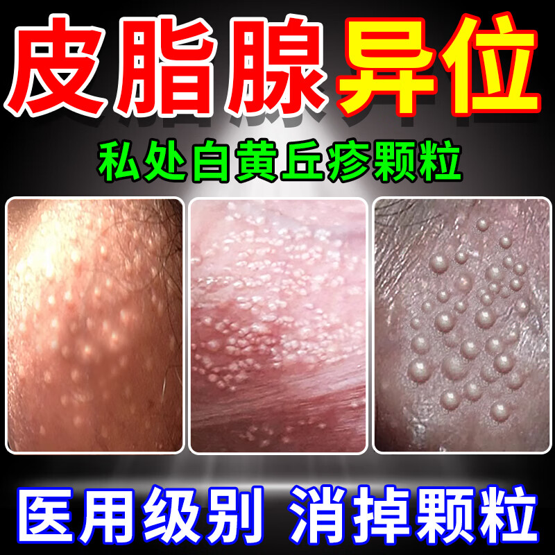 皮脂腺异位症私处男女皮脂腺囊肿增生阴囊阴茎小疙瘩白点增生喷剂 买2