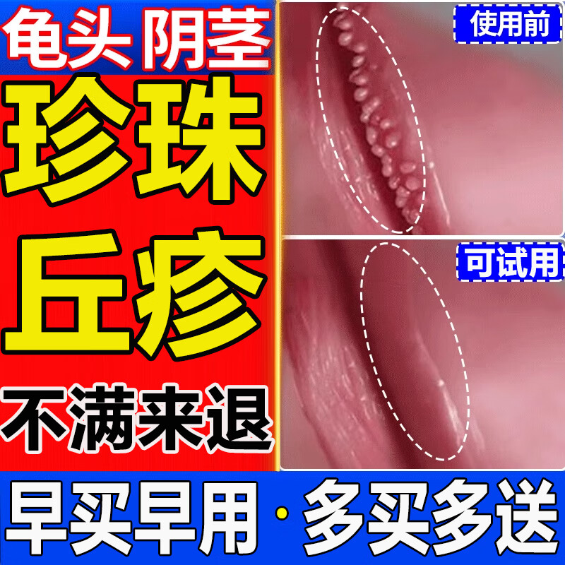 ftkh【大药房直发】珍珠疹可搭配去除非药品男性冠状沟珍珠疹丘疹珠粒