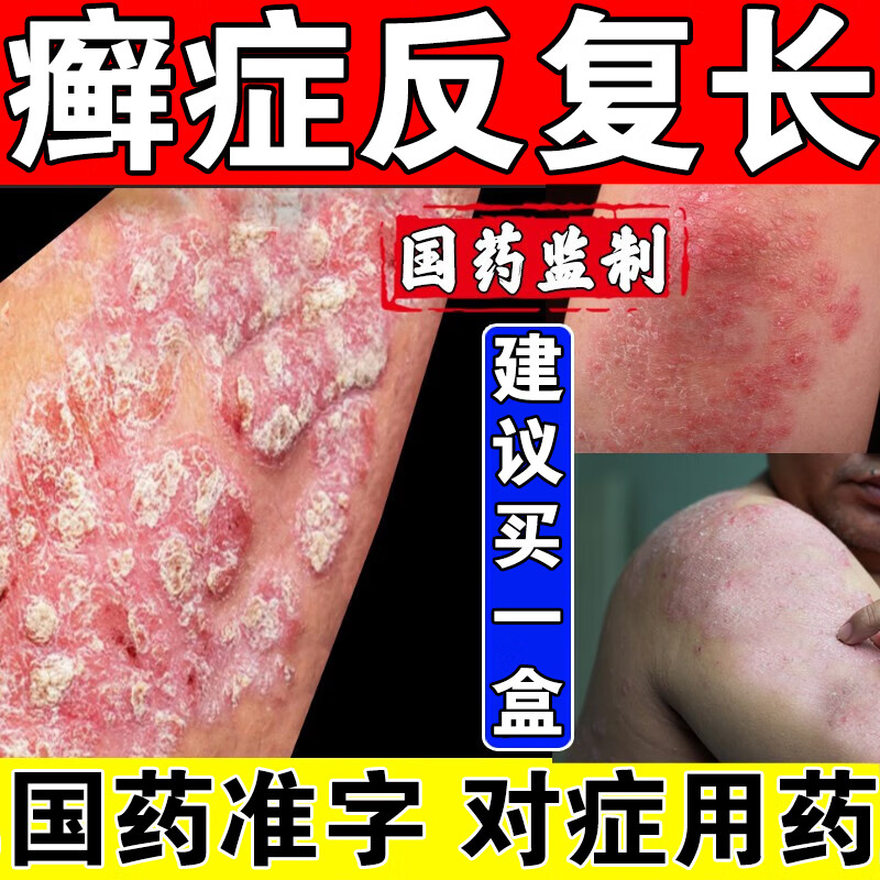 顽固牛皮癣银屑病湿疹皮肤瘙痒抑菌杀菌手足癣皮肤病用药中药口服 疗
