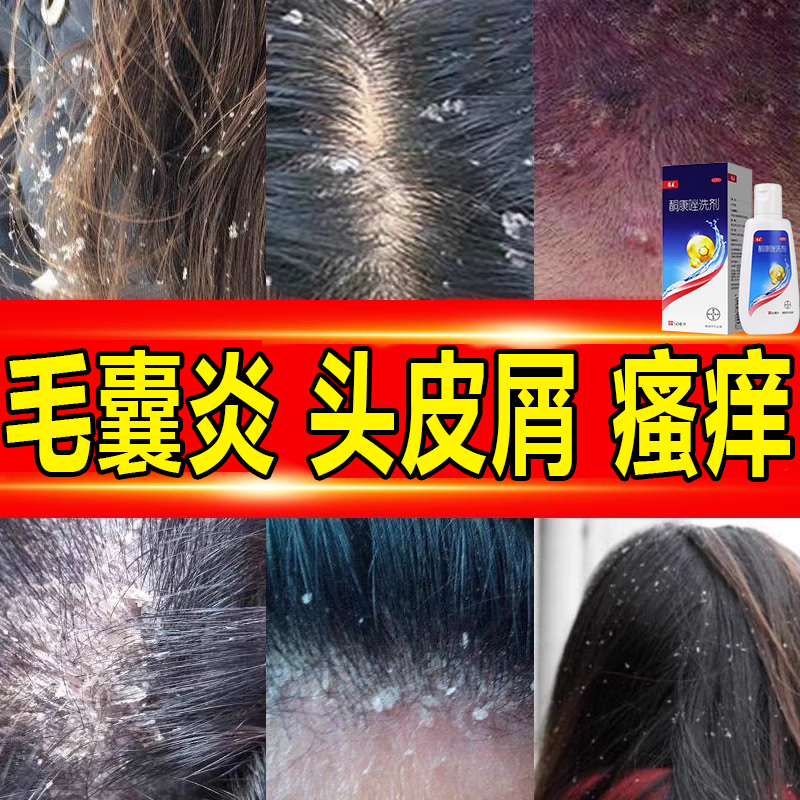 头痒真菌头皮屑多毛囊炎头部【成人专用】药康王洗发水去屑止痒皮炎