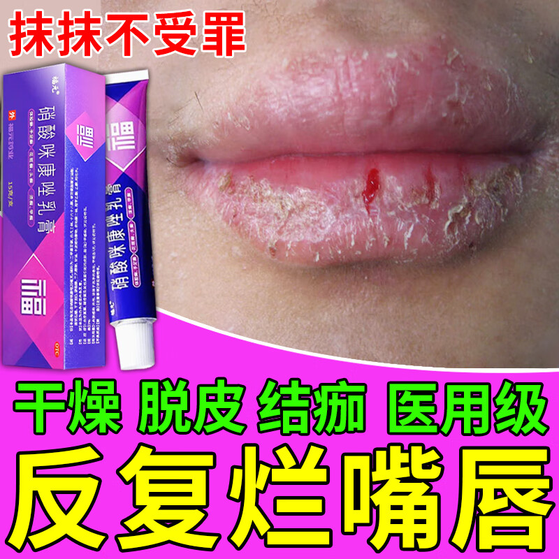 唇炎药医用膏慢性唇炎唇膏嘴唇干裂 嘴脱皮起皮裂嘴口角炎烂嘴角药膏