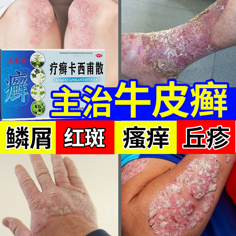 牛皮癣用药 牛皮癣银屑病皮肤瘙痒皮炎体癣皮肤干燥红斑丘疹脱屑燥湿