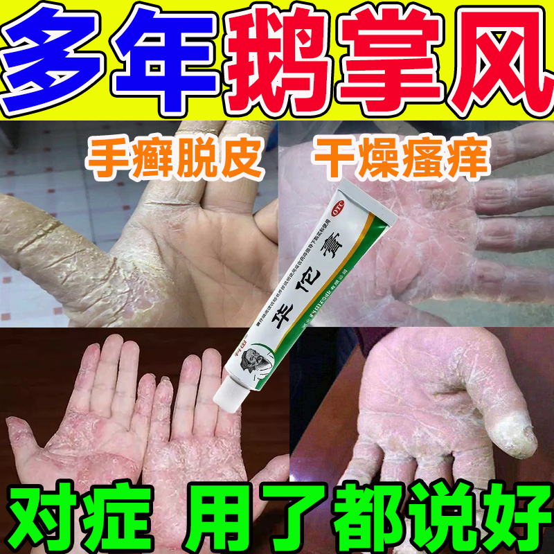 止痒抑菌瘙痒皮肤干裂脱皮起泡真菌感染治鹅掌风专用外用药膏华佗膏