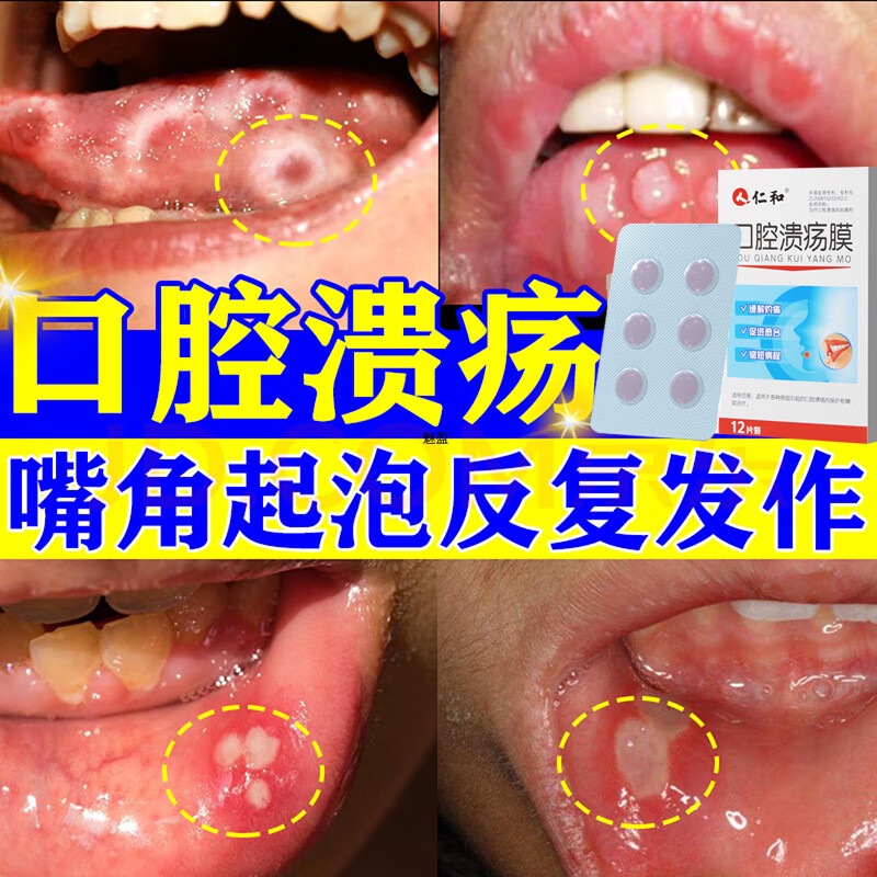 口腔溃疡贴片儿童成人嘴巴舌头起泡烂口疮专用贴上火口腔溃疡一口贴片