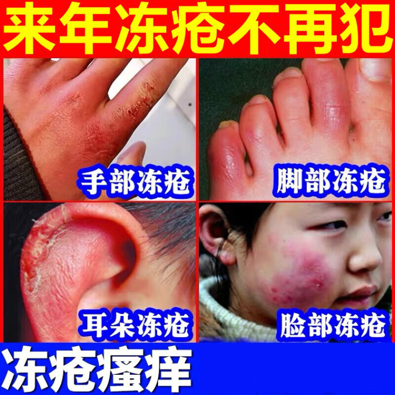 巅独蜂冻疮膏治神器护手霜预防裂皲裂修复的宝王冻伤耳朵专用一抹灵消