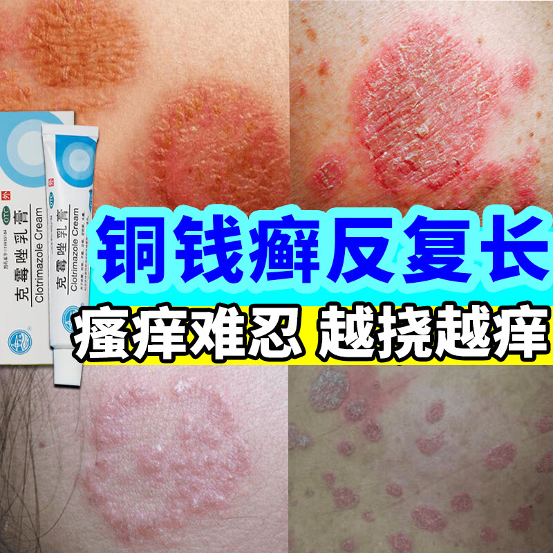 铜钱癣专用otc药膏治由真菌感染引起的铜钱癣 皮肤瘙痒难耐越挠越痒抗