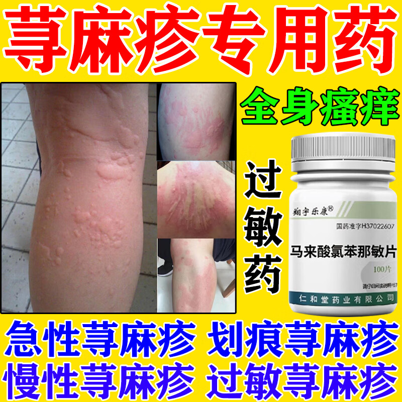 皮肤过敏瘙痒红疹长疙瘩红点 荨麻疹止痒药 马来酸氯苯那敏片100片 2