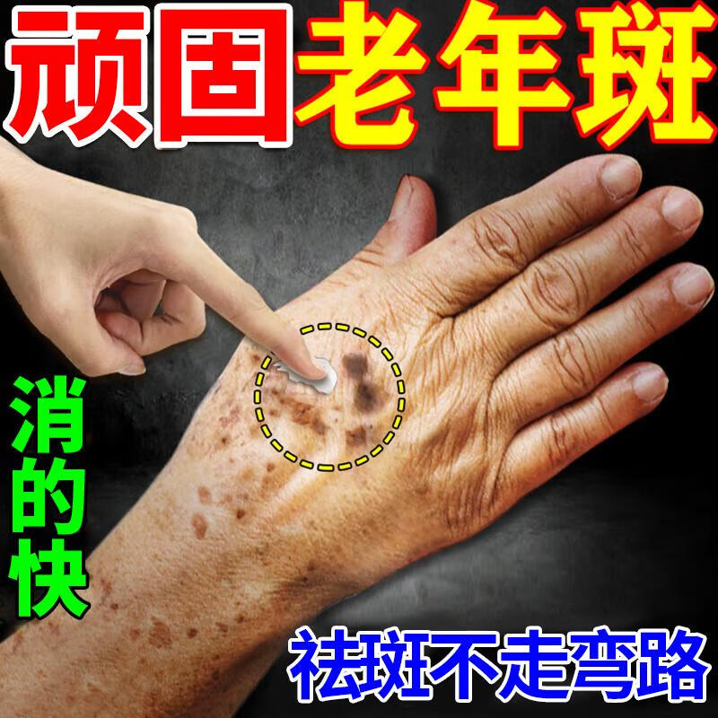 美白祛斑霜 强力去除老年斑淡化黑色素黄褐斑手部手背脸部淡斑祛斑霜