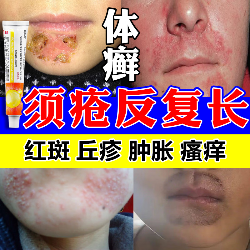 止痒膏皮肤瘙痒皮肤瘙痒皮炎湿疹须疮羊胡子疮体癣股癣花斑癣真菌感染