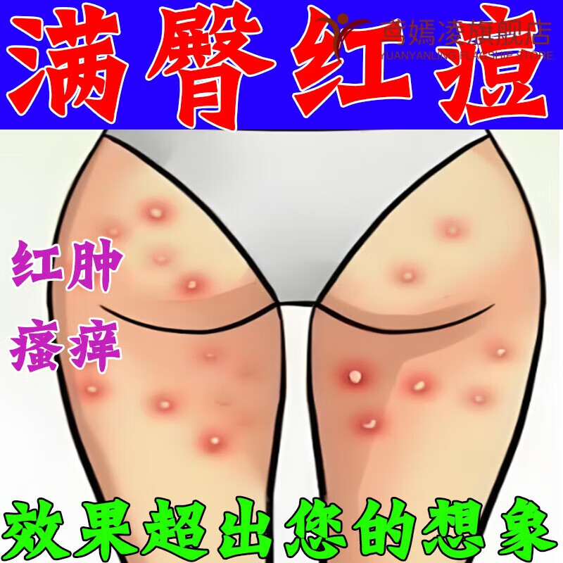 熏姿颜屁股痒起疙瘩屁股上长痘痘屁股上久坐长疙瘩止痒肛门痒潮湿痒藓