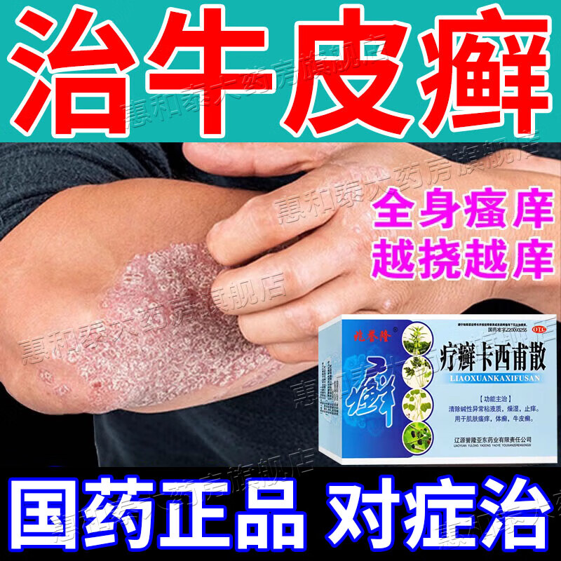 【治牛皮癣药】银屑病瘙痒红肿皮肤脱屑鳞屑干裂掉皮 口服治癣中药
