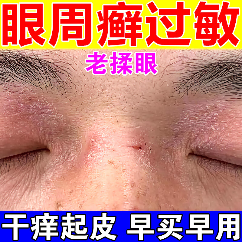 眼皮癣眼角痒脸上起癣干皮神经性皮炎眼皮红肿痒过敏干燥眼周皮肤脱屑