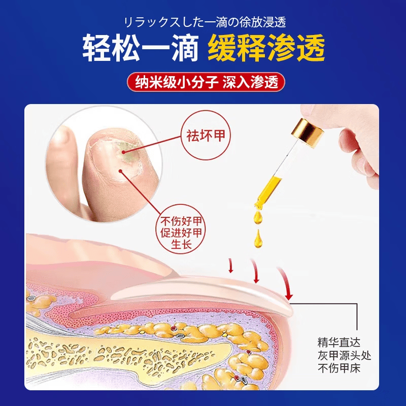 宫本田中日本灰指甲特傚效第1名根i治正品真菌感染增厚灰指甲进口专用抑菌 一盒【专冶灰甲】进口药