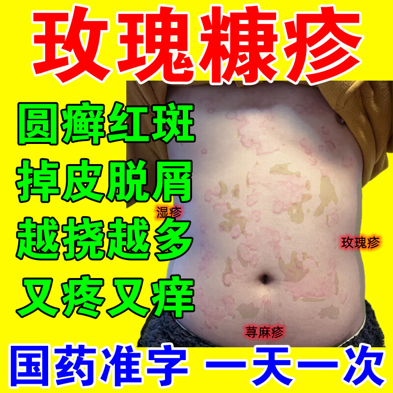 玫瑰糠疹专用药膏】红斑瘙痒脱皮鳞屑治皮肤瘙痒皮炎湿疹丘疹型荨麻疹