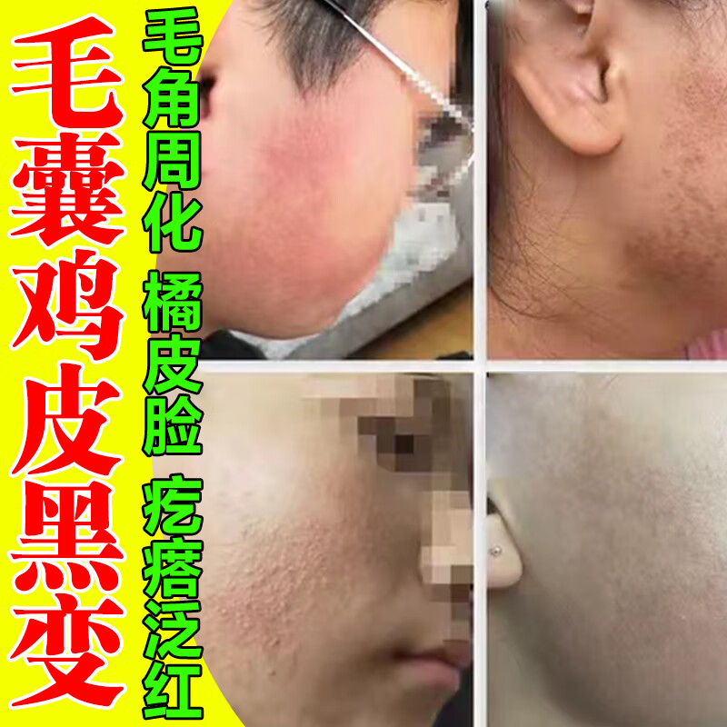 面部毛囊性红黑变病鸡皮肤疙瘩囊角化膏涂抹毛周角化症脸部橘皮脸专用