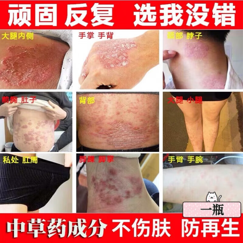 帅榜宛医堂湿毒康芙乐草本肤乳膏乐芙湿毒清百草软膏 一瓶装 去橘皮