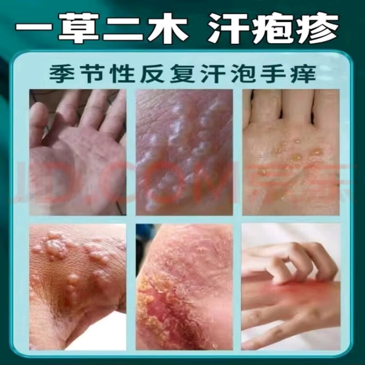 一草二木汗l疱l疹手上起小水泡手痒手脚脱皮干裂手足l藓真菌感染 买3+2【五盒巩固装】