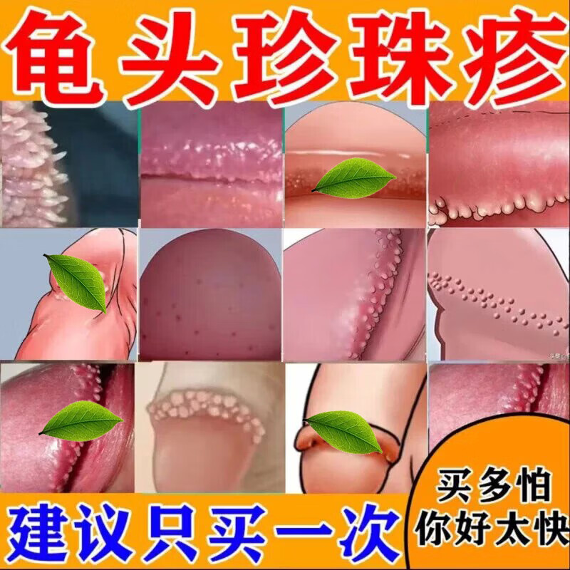 私处护理洗液龟头红肿红斑糜烂瘙痒霉菌念珠型包皮炎排尿疼痛真菌感染