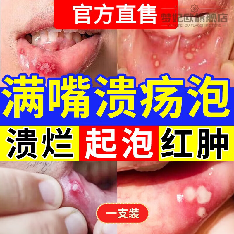 梦妃欧金口馨口腔溃疡专用牙膏嘴巴起泡口舌生疮上火疼痛牙龈牙周 1支体验装 官方直售