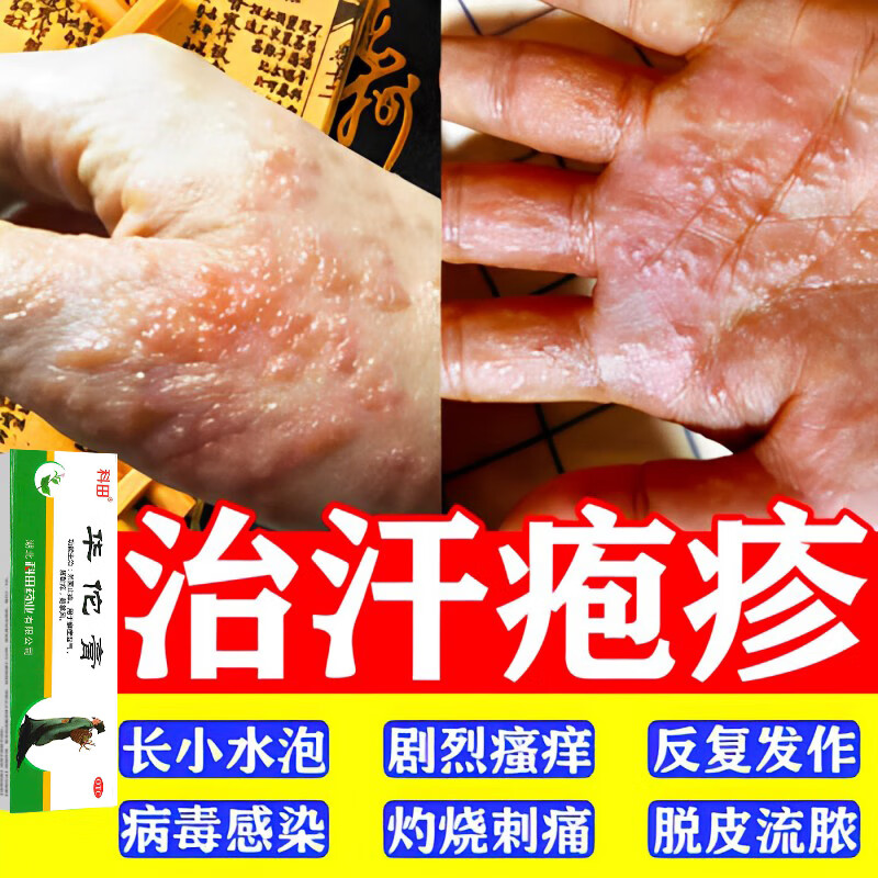 手上起小水泡】治汗疱疹用的药膏湿疹鹅掌风手癣瘙痒真菌感染脱皮杀菌