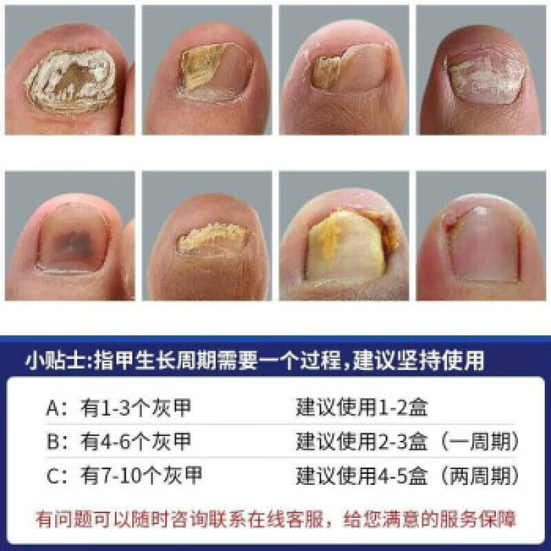 盐酸阿莫罗芬搽剂擦灰指甲专用乳膏真菌感染甲沟炎脱坏 1盒装搽剂+棉签