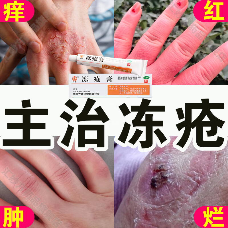 冻疮膏止痒冻伤膏 冻疮膏冻疮专用otc药 特止痛效冻疮膏成人治手足根