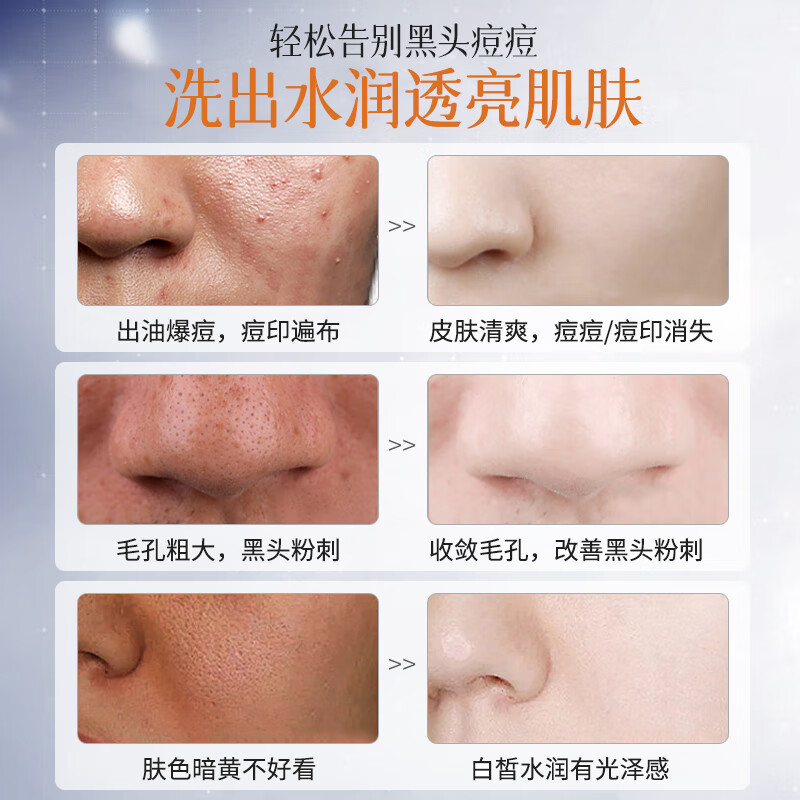 茵倩洗面奶377氨基酸美白淡斑洁面乳控油祛黑头收缩毛孔补水保湿男女 【净澈祛痘淡斑】美白洗面奶120g
